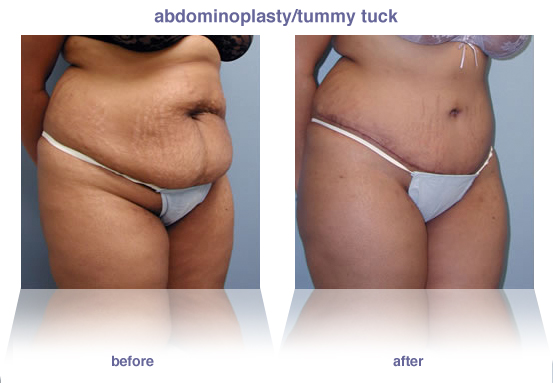 abdominoplasty / tummy tuck