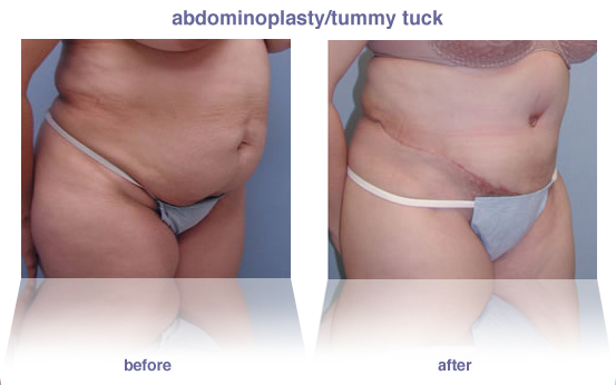 abdominoplasty / tummy tuck
