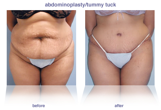 abdominoplasty / tummy tuck