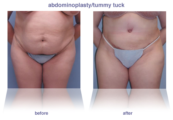 abdominoplasty / tummy tuck