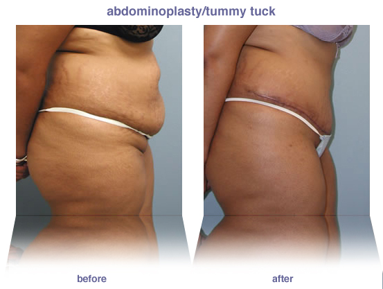 abdominoplasty / tummy tuck