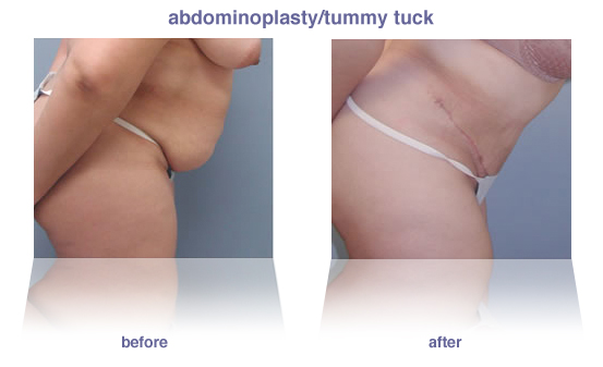abdominoplasty / tummy tuck