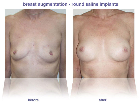 breast augmentation
