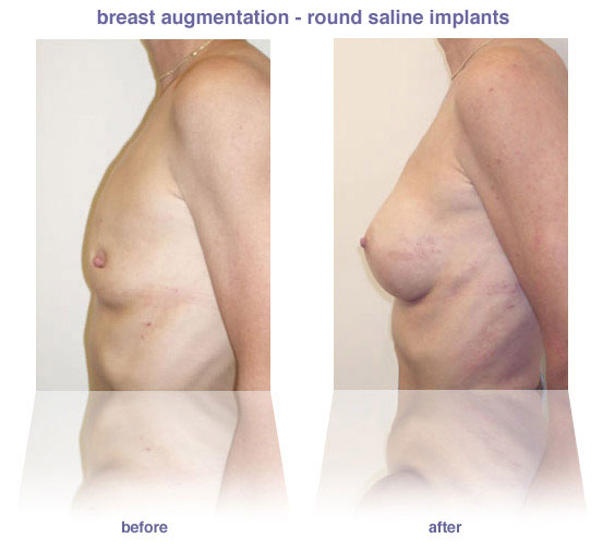 breast augmentation