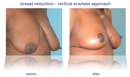 breast reduction