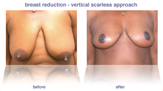 breast reduction