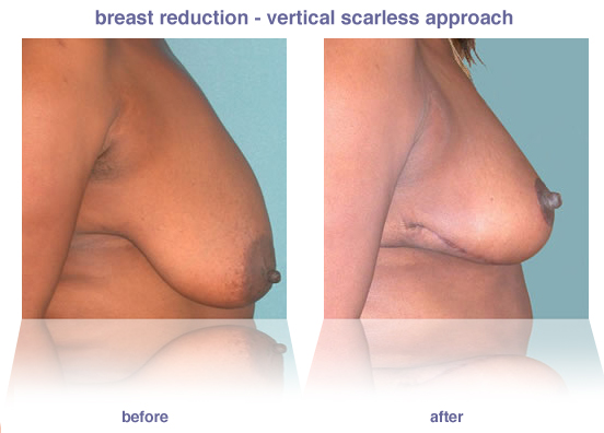 breast reduction