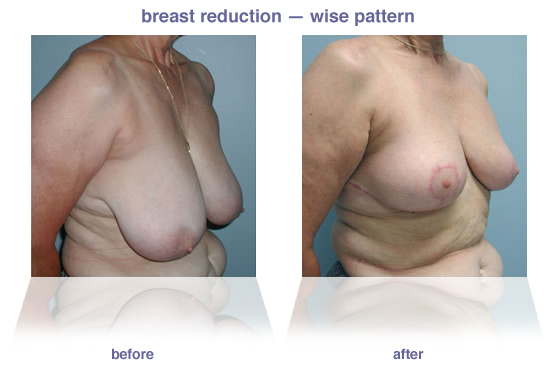 breast reduction