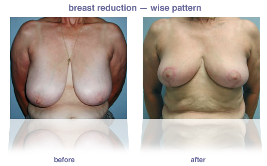 breast reduction