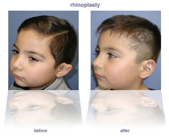 Ear Reconstruction