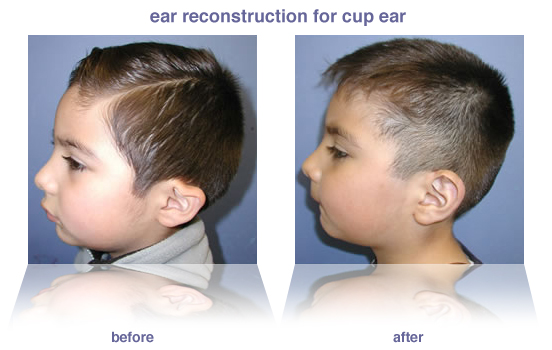 Ear Reconstruction