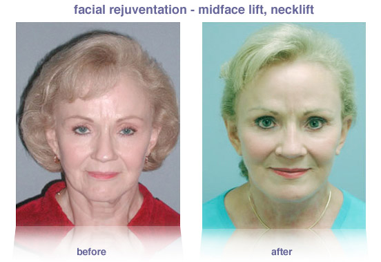 Facelift