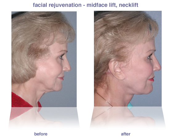 Facelift