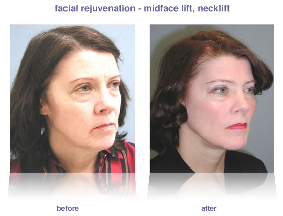 Facelift