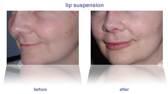 lip enhancement