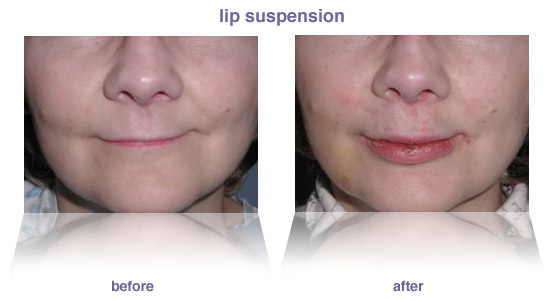 lip enhancement