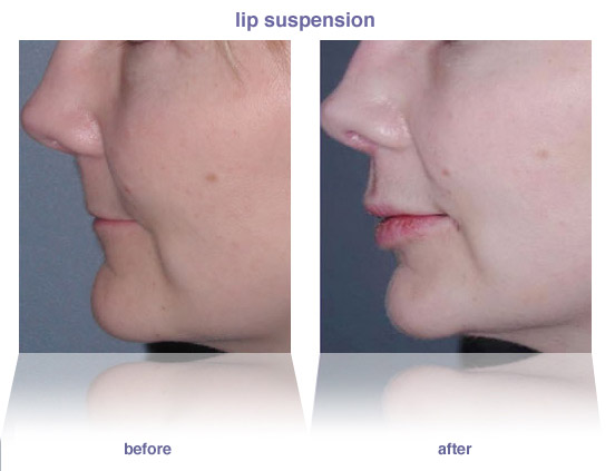 lip enhancement
