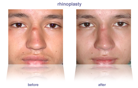 rhinoplasty