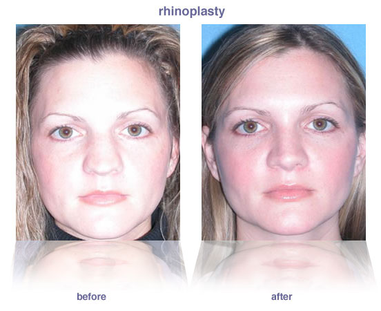 rhinoplasty