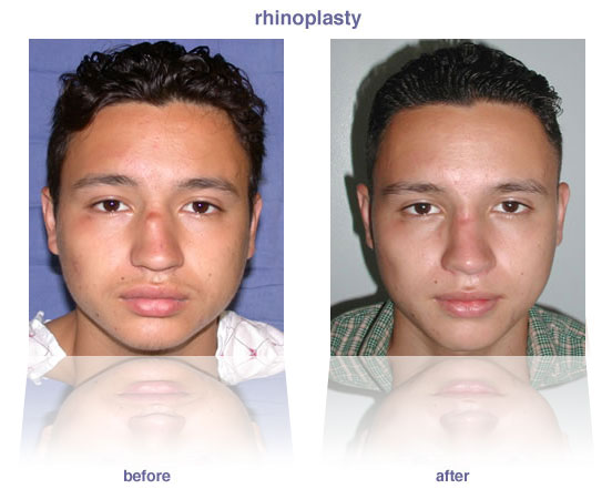 rhinoplasty