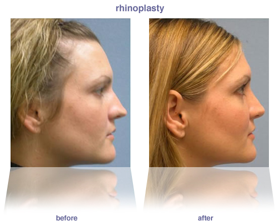 rhinoplasty