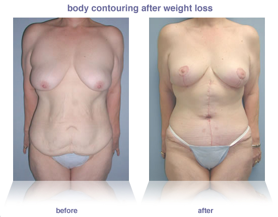 Weight Loss