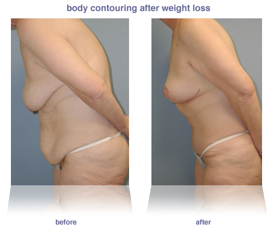 Weight Loss