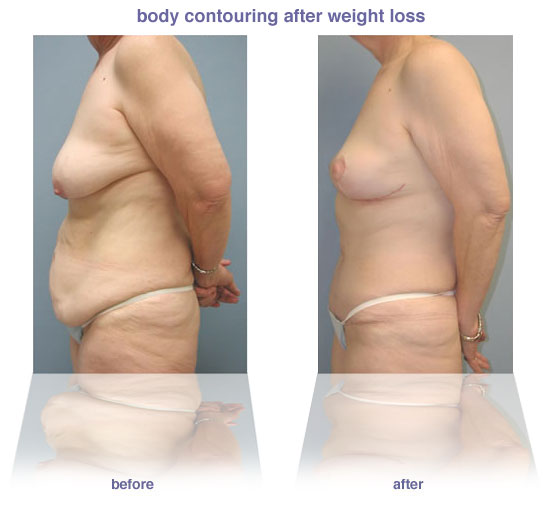 Weight Loss